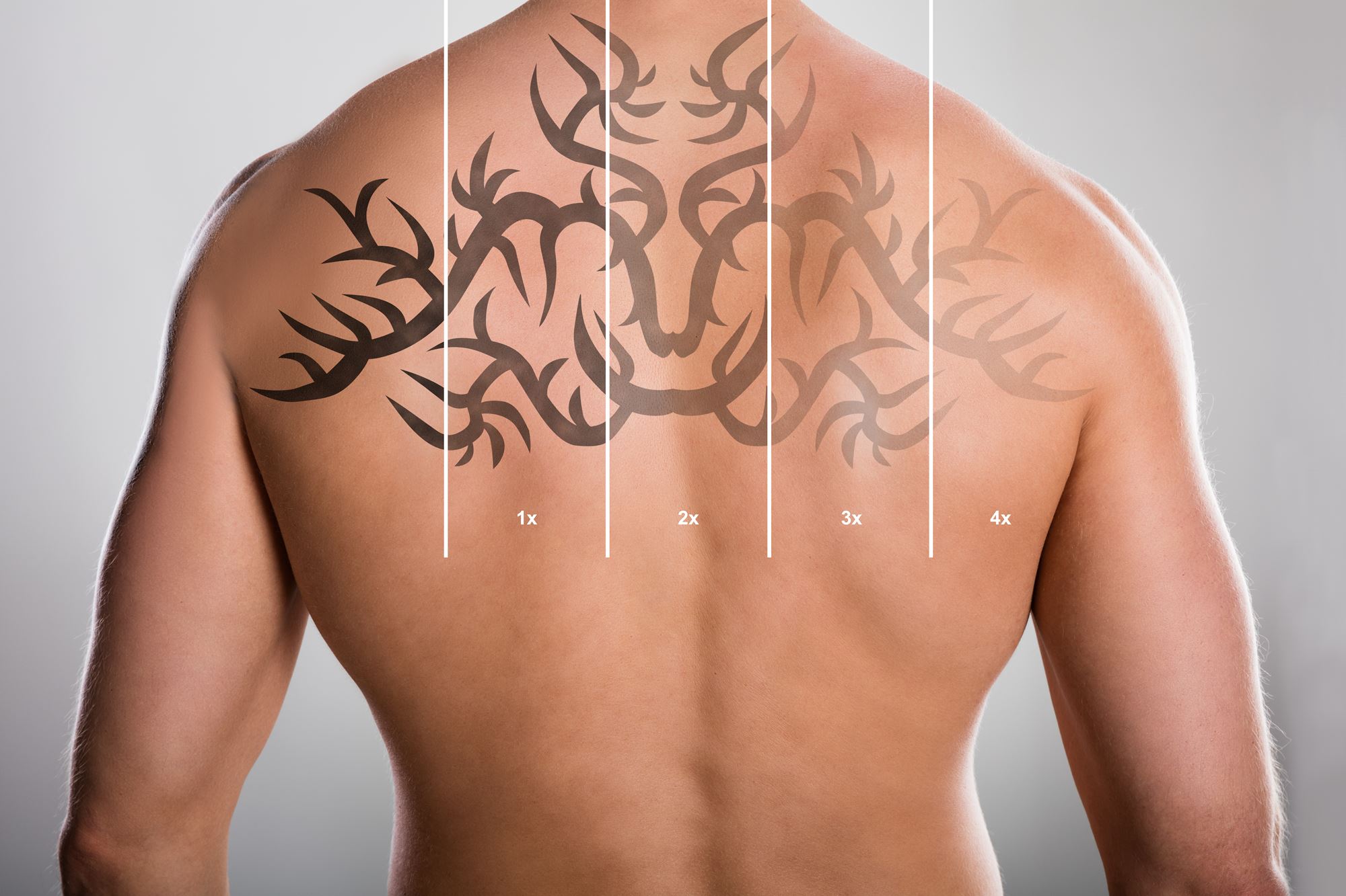 Laser Tattoo removal graph on shirtless man
