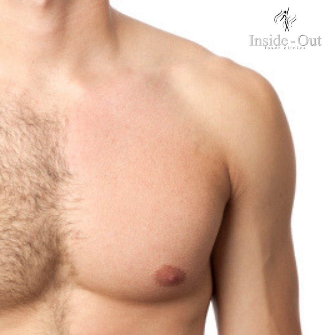 Male and Transgender Hair Removal