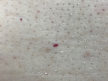 Male and Transgender Hair Removal